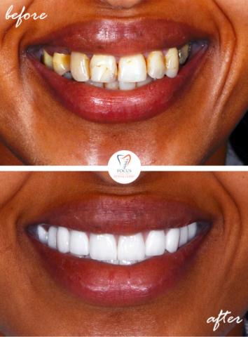 Focus Dental Clinic Bodrum Turkey Before After