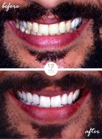 Focus Dental Clinic Bodrum Turkey Before After