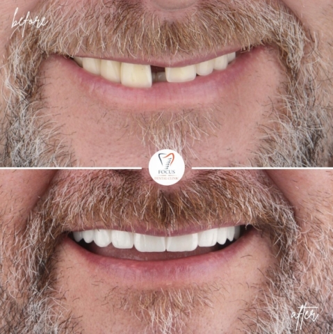 Focus Dental Clinic Bodrum All on 4 Before After