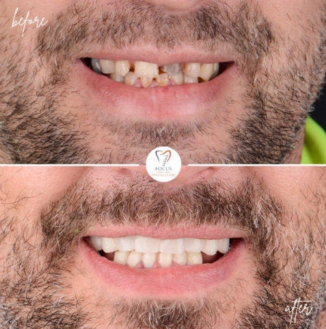 Focus Dental Clinic Bodrum All on 6 Before After