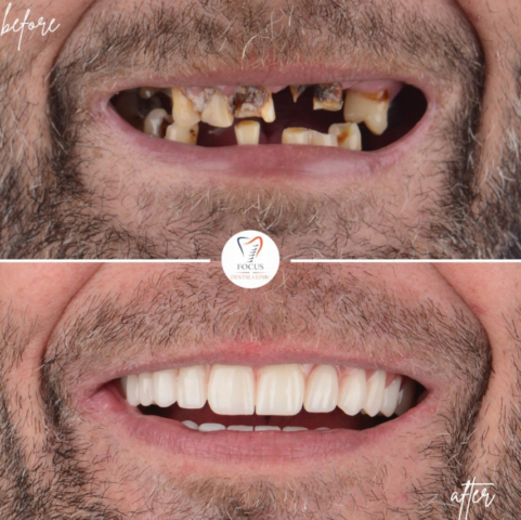 Focus Dental Clinic Bodrum All on 6 Before After