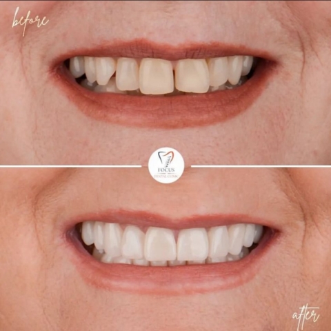 Focus Dental Clinic Turkey E-max & Zirconia Laminate Veneers Before After