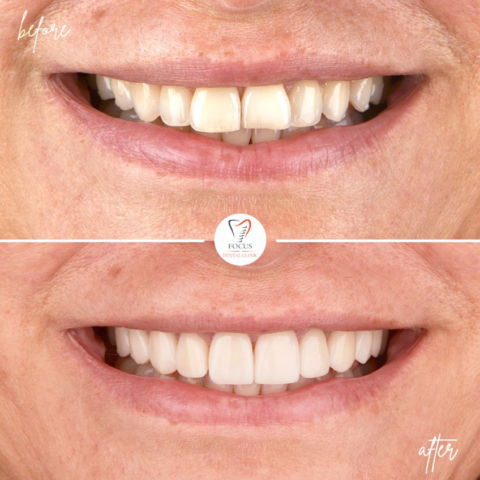 Focus Dental Clinic Turkey E-max & Zirconia Laminate Veneers Before After