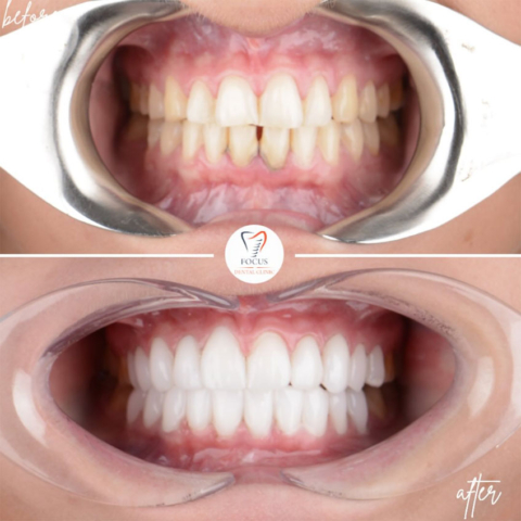 Focus Dental Clinic Turkey E-max & Zirconia Laminate Veneers Before After