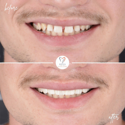 Focus Dental Clinic Turkey E-max & Zirconia Laminate Veneers Before After