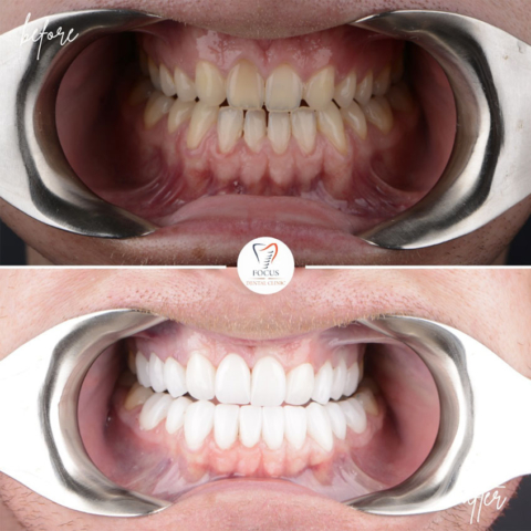 Focus Dental Clinic Turkey E-max & Zirconia Laminate Veneers Before After