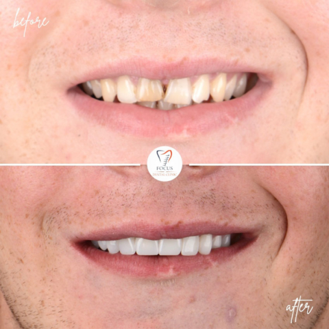 Focus Dental Clinic Turkey E-max & Zirconia Laminate Veneers Before After