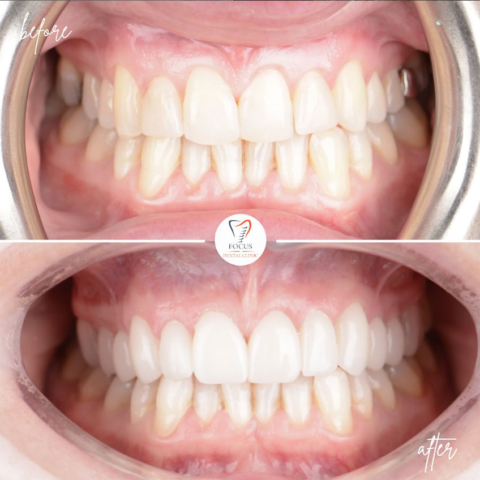 Focus Dental Clinic Turkey E-max & Zirconia Laminate Veneers Before After