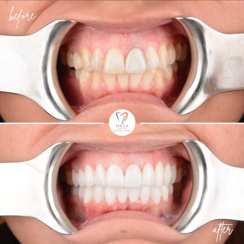 Focus Dental Clinic Turkey E-max & Zirconia Laminate Veneers Before After