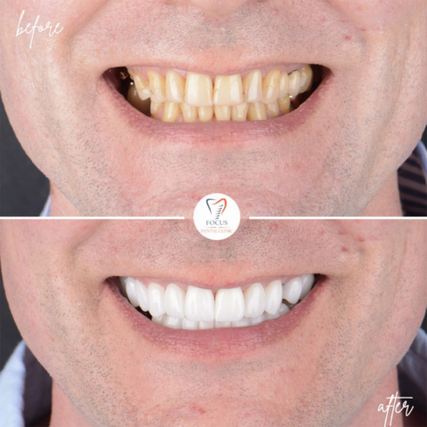 Focus Dental Clinic Turkey E-max & Zirconia Laminate Veneers Before After