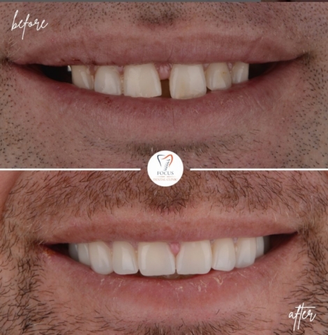 Focus Dental Clinic Bodrum Zirconia Crowns Before After