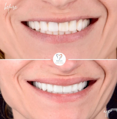 Focus Dental Clinic Bodrum Zirconia Crowns Before After